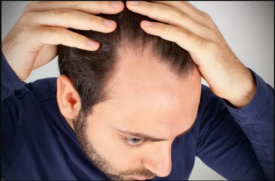Las 5 Mejores Clínicas de Trasplante Capilar Bilbao
